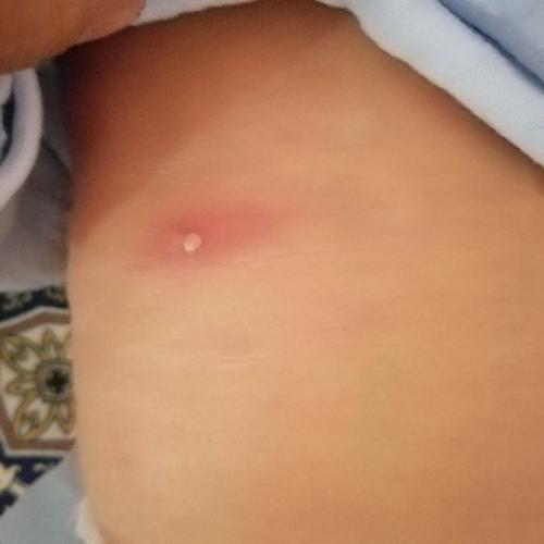 宝宝身上长了个脓包,着急死了