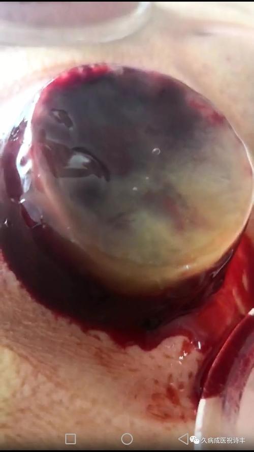 导致淤血的原因