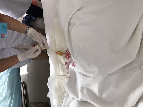 改良式膀胱冲洗