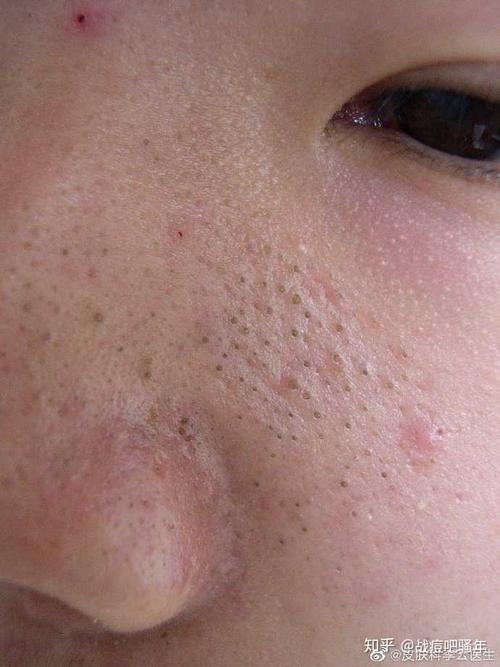 鼻子周围黑头粉刺图片