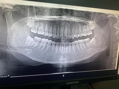 牙片鉴赏|有拔过埋伏智齿的uu吗?能否分享一下经验