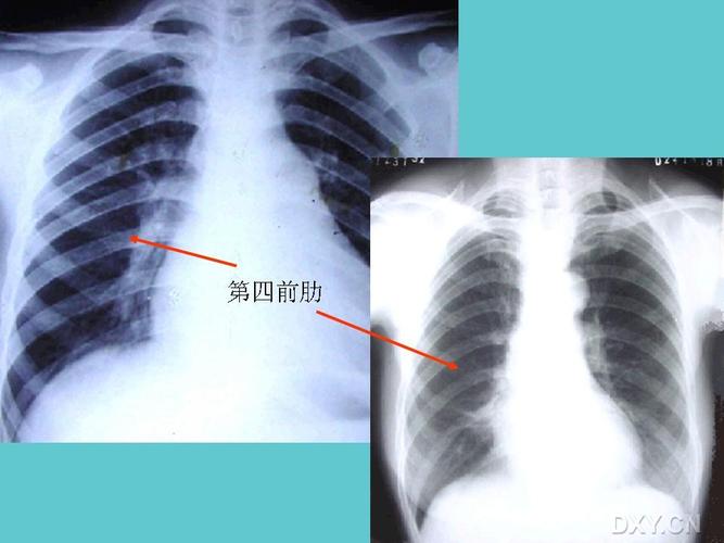 【请教】少量,中量,大量胸腔积液的划分标准是什么?