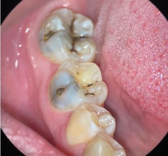 在线解答什么情况需要杀牙神经