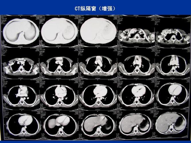 肺部常见疾病ct读片ppt