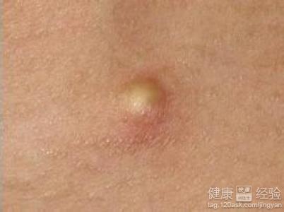 正文 多发性皮脂腺囊肿也被称为粉瘤,是因为皮脂腺导管阻塞后,腺内的