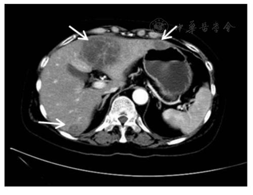 系统性红斑狼疮合并皮疽诺卡菌性肝脓肿患者肝胆胰脾ct