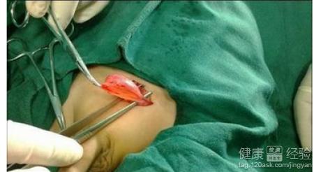 小儿精索鞘膜积液手术好吗