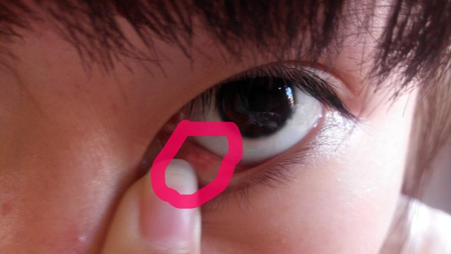 下眼皮内有个白色小疙瘩略疼.是怎么回事?