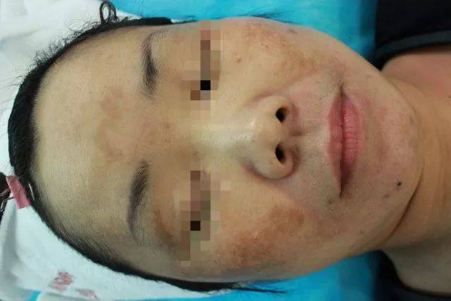 肝炎,慢性酒精中毒,甲亢,结核病,内脏肿瘤等)患者也可发生黄褐斑