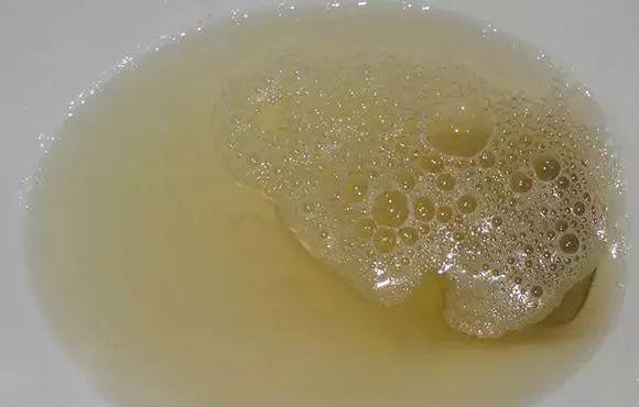 如果尿色较深尿中泡沫增多可能是肾病肾炎严重吗能治愈吗