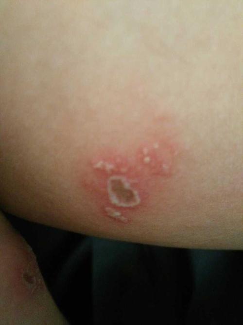 姐妹们,我腿上长了两小块这么大的疱疹,什么药能安全使用啊?