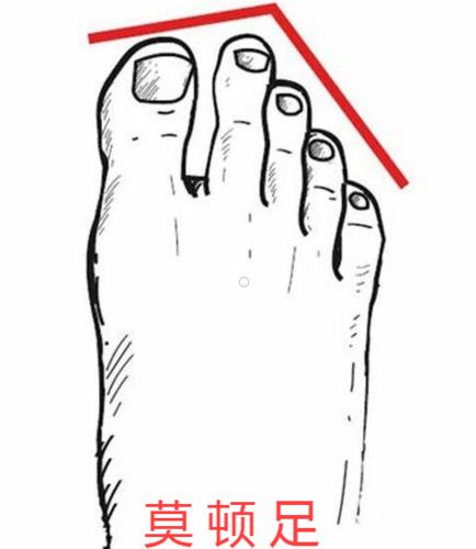 解构莫顿足难题它可能引发您的脚掌疼痛