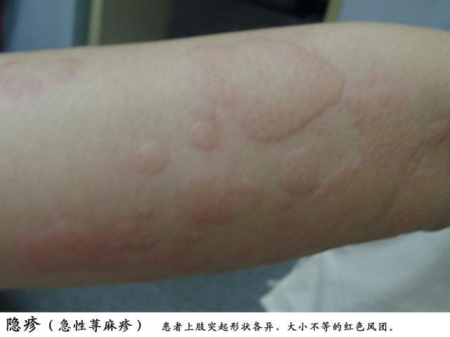 药物过敏图片