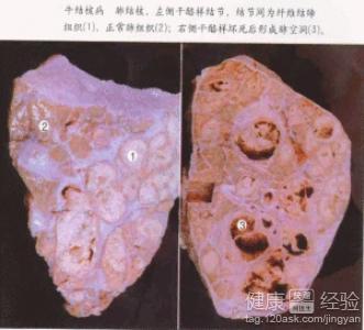 肺结核的治疗周期有多长_最真实的经验分享_健康经验