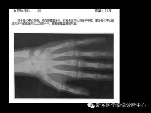 女生骨龄怎么看?出生到成年x线骨龄对照图谱大全