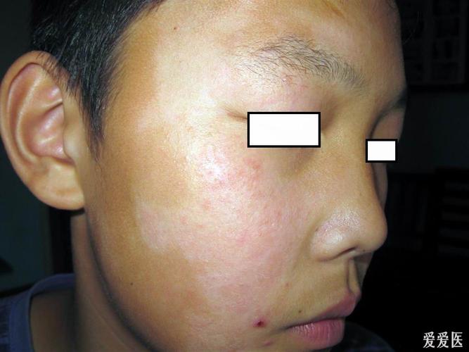 看图识病白色糠疹