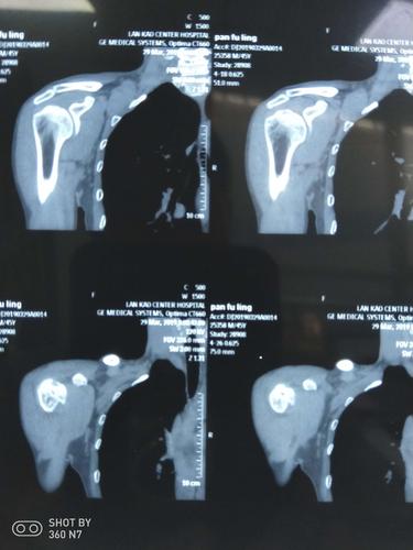 患者中年男性,46岁,以"右肩关节酸痛不适18个月"为主诉入院.