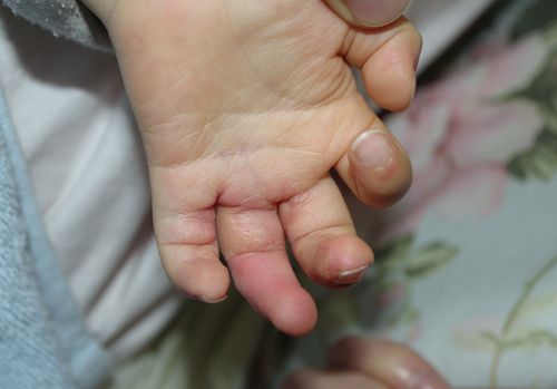 左手掌侧,指蹼完全正常
