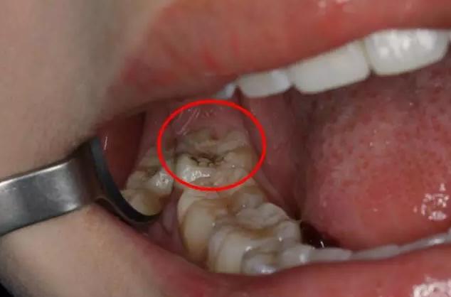 牙医告诉您,智齿到底用不用拔除