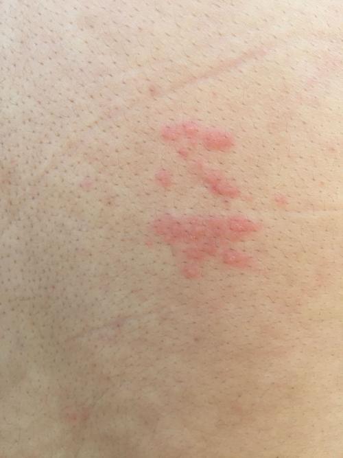 问:昨天早上起来发现后背(右下角,肾?的部位?)长了一堆有水泡的痘痘.