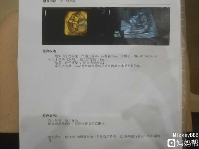 12周,新鲜出炉的nt,宝宝还挺配合的