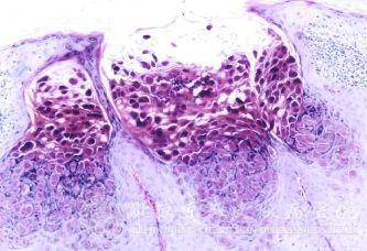 老年人阴囊湿疹小心癌变