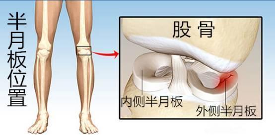 半月板后角撕裂