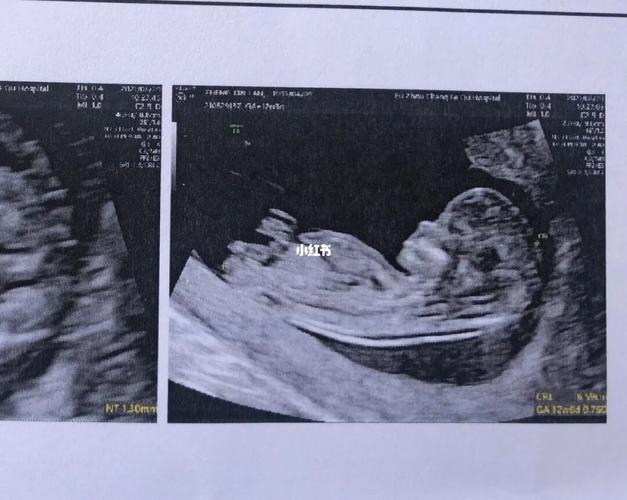 nt nub点看男女_nt检查_女宝_母婴_孕产经验