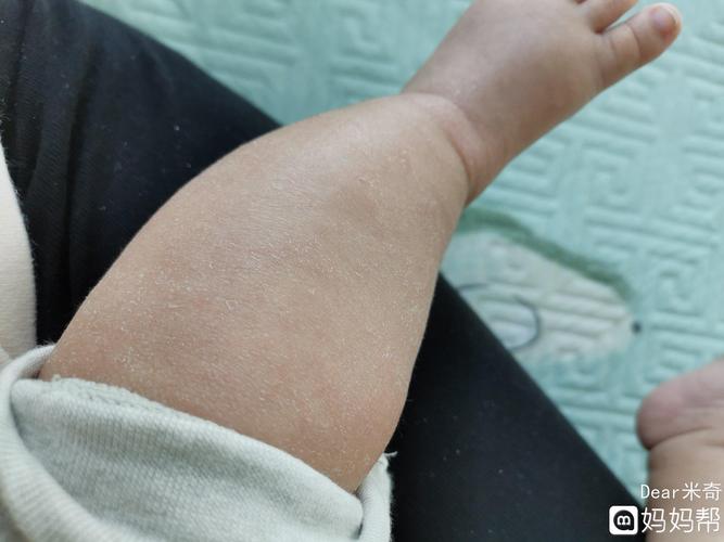 到底什么原因,是干性湿疹引起的吗?有知道的么