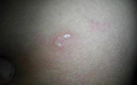 潜伏梅毒症状图片