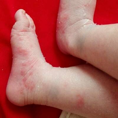 宝宝今天十天,脚上腿上忽然有好多小红点,一整天都没有消失,怎么办