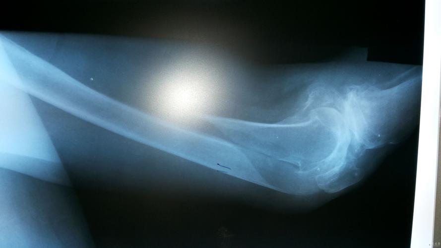 90岁股骨远端长螺旋形骨折