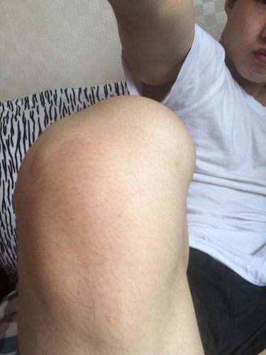 膝盖弯曲时膝盖骨往外翻 站立时候膝盖内侧上方会鼓包 还有膝盖弯曲时