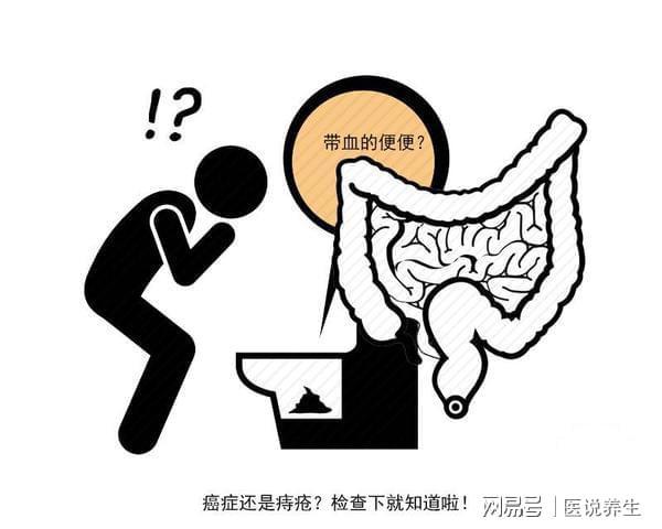 结肠癌不宜拖身体出现异常腹痛便血低热不退或已到晚期