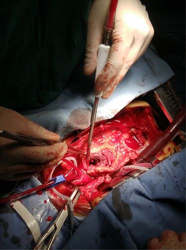 胸主动脉假性动脉瘤的外科治疗