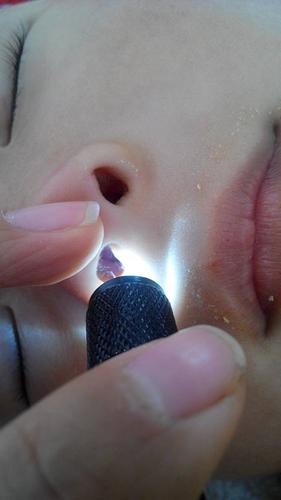 你好,2岁半的小孩,鼻子里面那个小肉疙瘩大,有时左边大,有时右边大,大