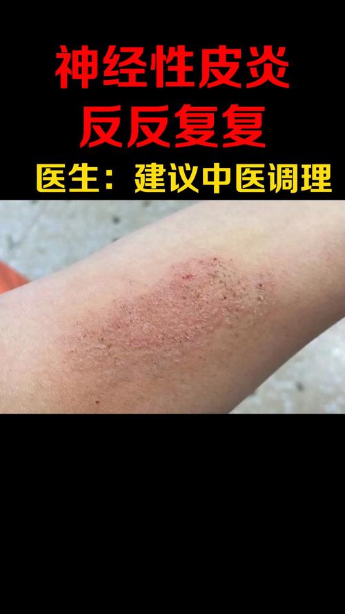 健康科普大姐患神经性皮炎反反复复越挠越痒医生建议吃中药调理