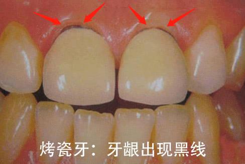 牙龈"黑线"问题:烤瓷牙金属内冠在口腔内氧化形成灰色氧化物,散在