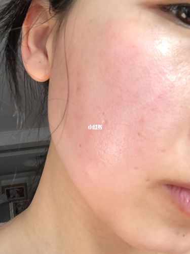 脸过敏泛红怎么办6315修复敏感肌我这样做的_修复敏感肌_敏感肌