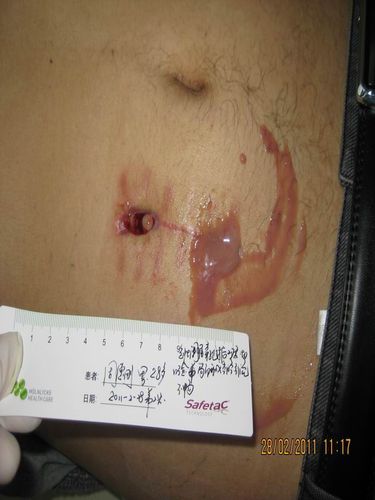 治愈1例急性阑尾炎切除术后窦道形成和腹壁下感染伤口