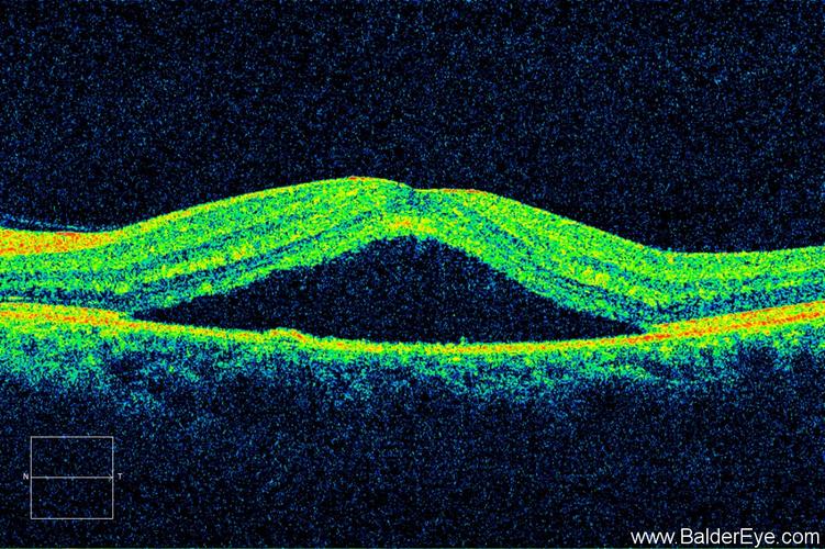 患者黄斑oct图
