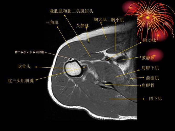 肩关节mri解剖ppt