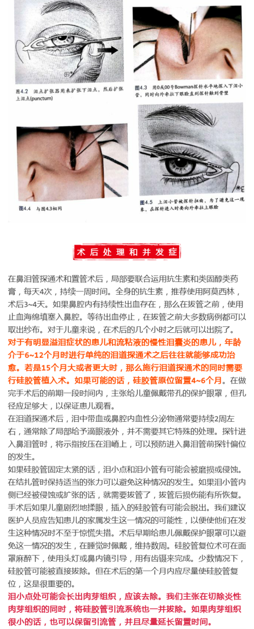 鼻泪管探通术及置管术