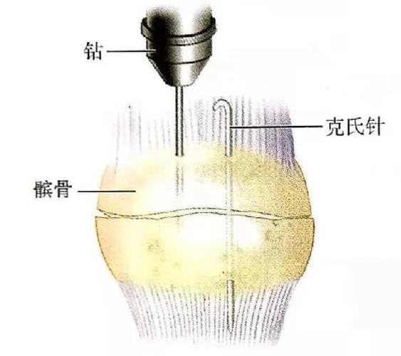 骨科小技巧髌骨骨折手术技巧