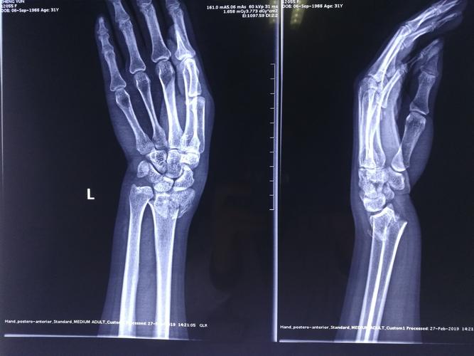 桡骨远端骨折的手法整复接骨术