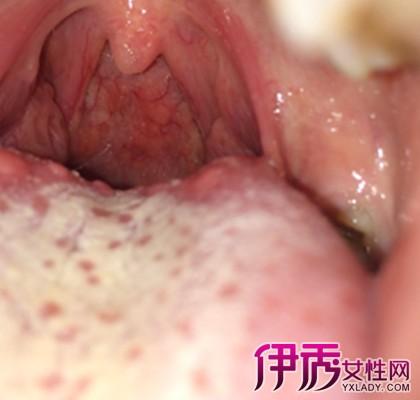 可能偶尔都会发现自己的舌头根部出现了一些小小的疙瘩,但是因为它并