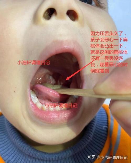 耗时十个月研究孩子扁桃体肥大终于在没有做手术的情况下恢复正常了