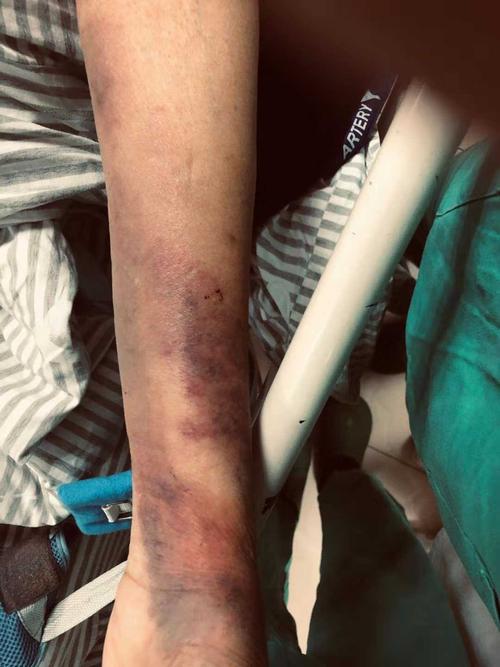 患者,男,94岁,去甲肾上腺素大面积外渗,都做好坏死的准备了,贴了薄片3