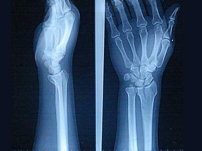 桡骨远端骨折
