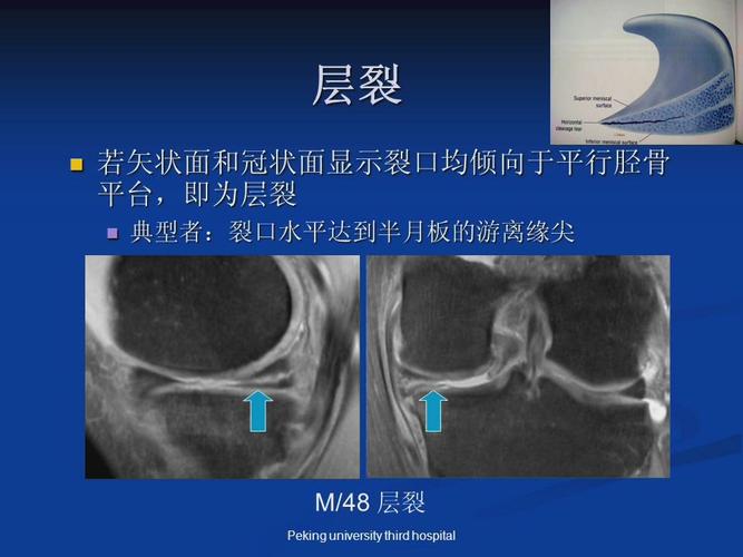 磁共振室业务学习～2019.07.05～膝半月板撕裂
